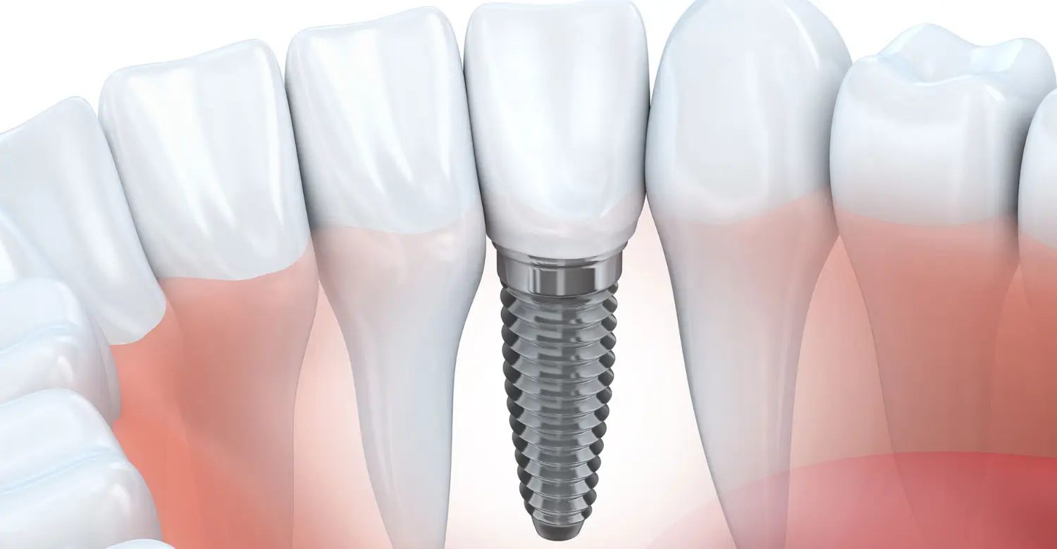 Emergency Dental Implant 2